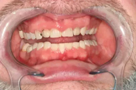Close-up of an open mouth with teeth and gums exposed using a cheek retractor.