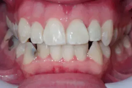 Close-up of a mouth showing misaligned teeth and gums with braces removed or absent.