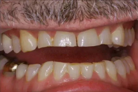 Close-up of a mouth with teeth visible, showing a wide gap between the upper and lower teeth.