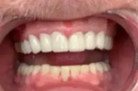 Close-up of an open mouth showing upper and lower teeth and pink lips.