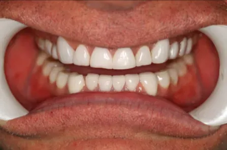 Close-up of a mouth with white teeth and red gums, held open by cheek retractors.