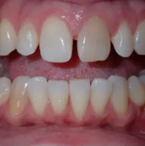 Close-up of a smiling mouth showing upper and lower teeth with a gap between the front teeth.