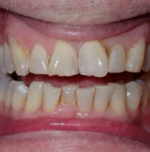 Close-up of teeth with visible yellow staining and gaps between the upper and lower front teeth.
