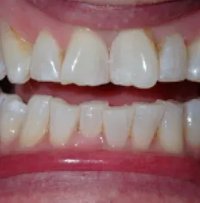 Close-up of a person’s smiling mouth showing aligned white upper and lower teeth.