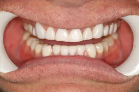 Mouth with teeth exposed by cheek retractors, showing gums and dental examination view.