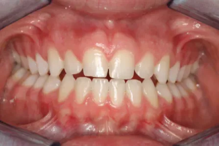 Close-up of an open mouth showing teeth and gums with braces removed.