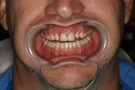 Close-up of a mouth held open with a cheek retractor, showing teeth and gums during a dental exam.