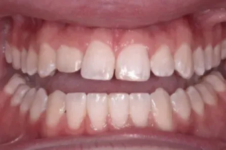 Close-up of a mouth with upper and lower teeth visible, showing a gap between the front teeth.