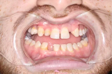 Close-up of a mouth with teeth spread open, showing dental discoloration and gaps.