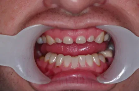 Close-up of a mouth held open with dental cheek retractors, showing teeth and gums.