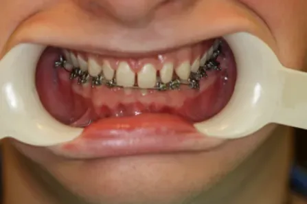 Mouth held open with a cheek retractor, showing upper and lower braces on teeth.