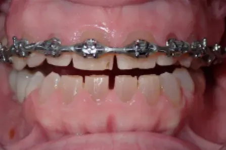 Close-up of teeth with metal braces on upper and lower rows, mouth slightly open.