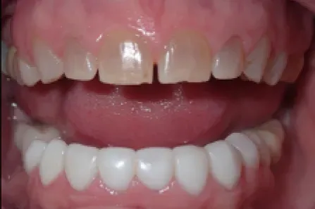 Close-up of a smiling mouth showing white teeth and a prominent gap between the front teeth.
