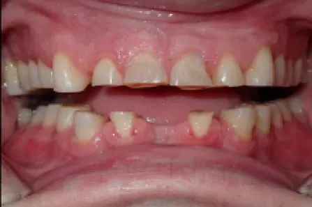 Close-up of an open mouth showing damaged, irregular teeth and a missing lower front tooth.