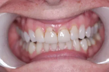 Close-up of a mouth showing clenched teeth with noticeable yellowing and crowding.