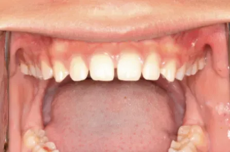 Close-up of an open mouth showing teeth and gums with a tongue visible.