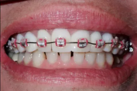 Close-up of teeth with braces and red elastic bands on the front teeth.