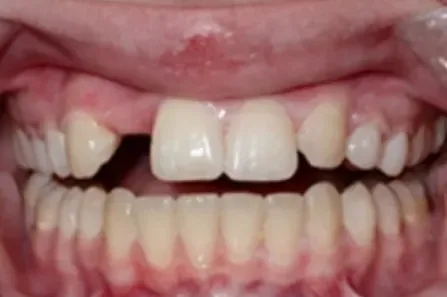 Close-up of a mouth with teeth visibly gapped and misaligned, showing upper and lower teeth.
