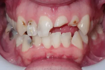 Close-up of a mouth with crowded, misaligned teeth and visible discoloration and gaps.