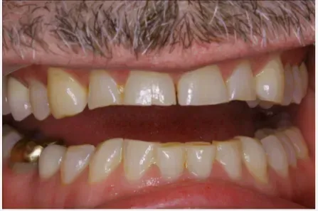 Close-up of stained, misaligned teeth with lips parted and gums visible