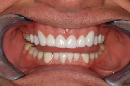 Close-up of a mouth with retractors, showing upper and lower teeth and gums during a dental exam