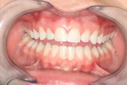 Close-up of a person's mouth showing teeth with gums and lips pulled back by cheek retractors