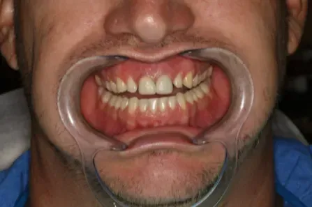Close-up of a person wearing a cheek retractor, showing teeth and gums during a dental exam