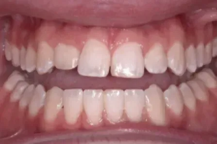 Close-up of a smiling mouth with teeth visible, showing upper and lower front teeth