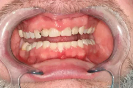 Close-up of a mouth with teeth exposed by cheek retractors, showing teeth and gums.