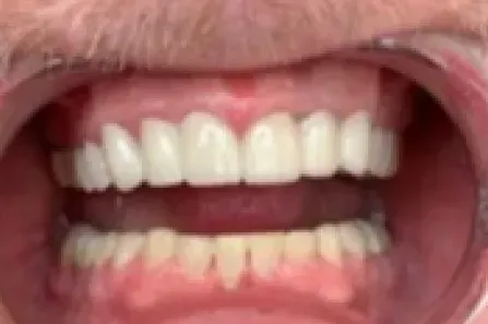 Close-up of an open mouth showing white upper and lower teeth with pink lips