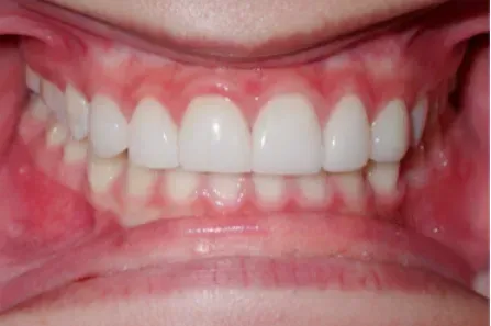 Close-up of teeth and gums with red, inflamed tissue visible around the upper teeth