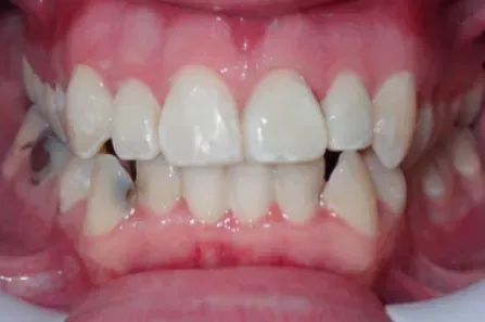 Close-up of teeth and gums with a misaligned bite and visible crowding