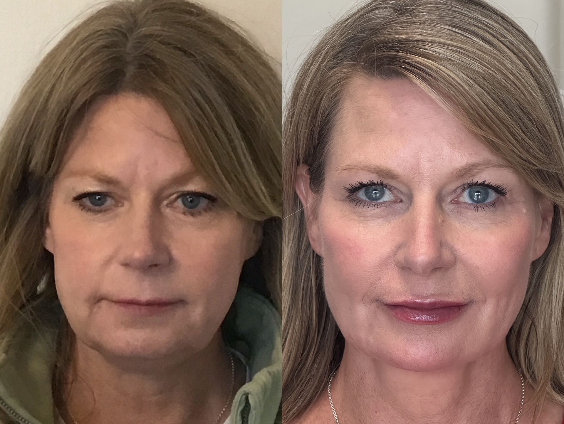 Before and after photos of a woman's face; showing a noticeable improvement in skin appearance with a softer jawline and smoother skin.