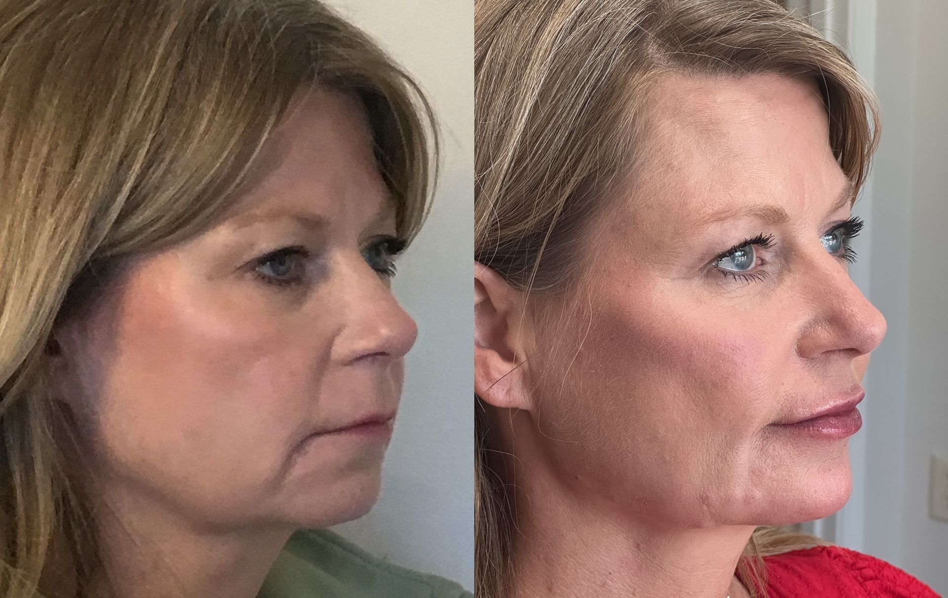 Side-by-side comparison: a woman's face before and after a procedure. Smoother skin and fuller lips are visible on the right.