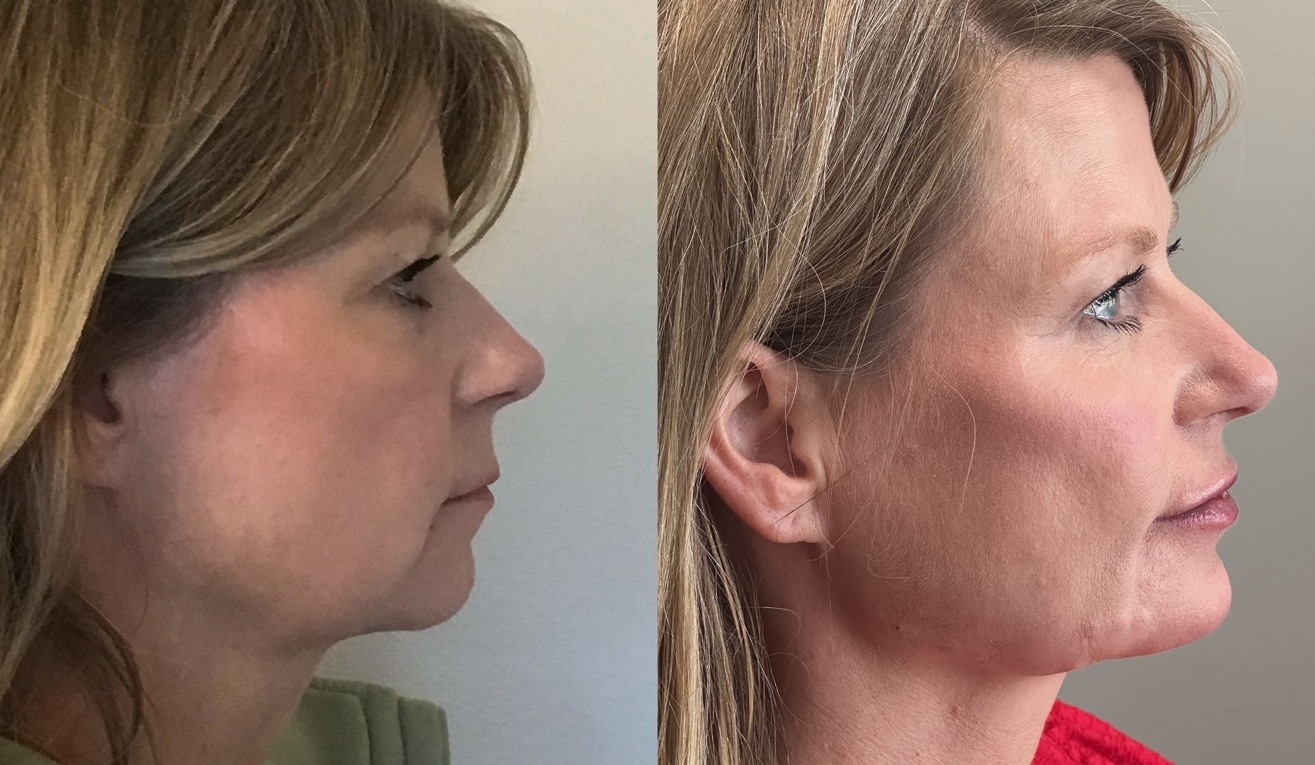 Side-by-side view of a woman's face showing before and after cosmetic work; face appears lifted and more defined in the after photo.