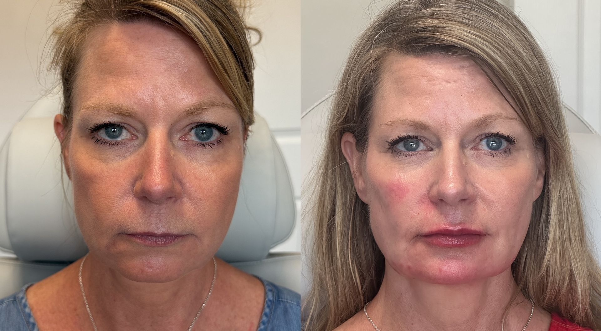 A side-by-side comparison shows a woman's face before and after a cosmetic procedure. Skin appears smoother in the after photo.