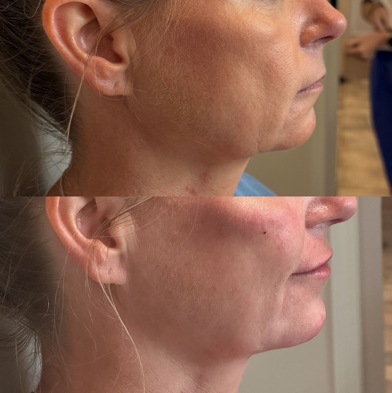 Before and after view of a woman's profile, showing improved jawline definition after a cosmetic procedure. The after image shows a tighter neck and less sagging.