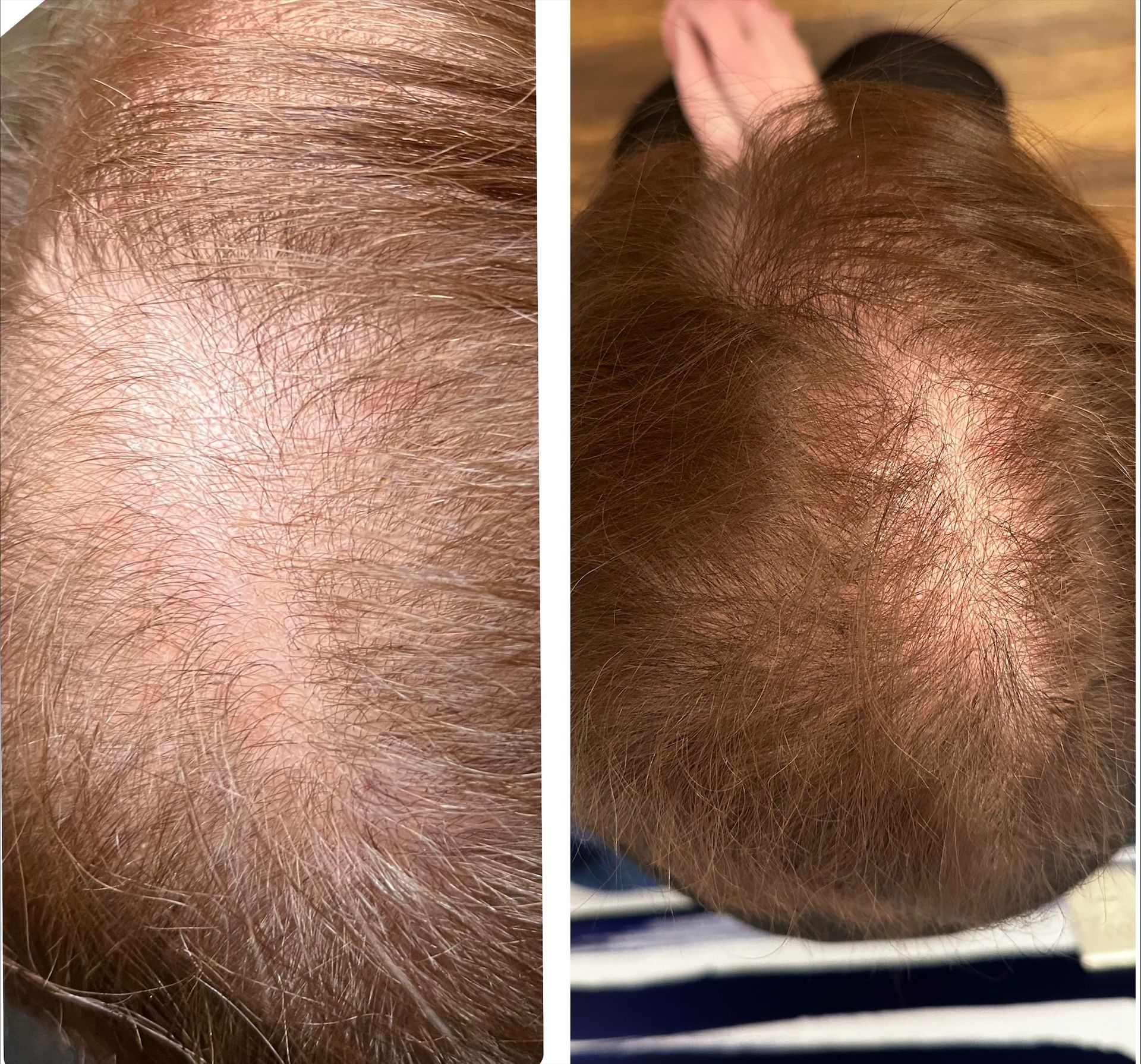 Two images of a person's scalp, showing hair thinning. The left image shows a top-down view with sparse hair. The right image shows more hair with someone touching their head.