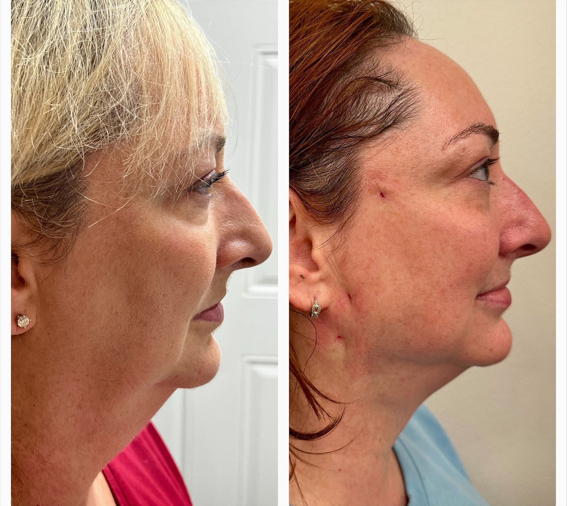 Side-by-side view of a woman before (left) and after (right) a cosmetic procedure, showing a lifted neck and improved facial contour.