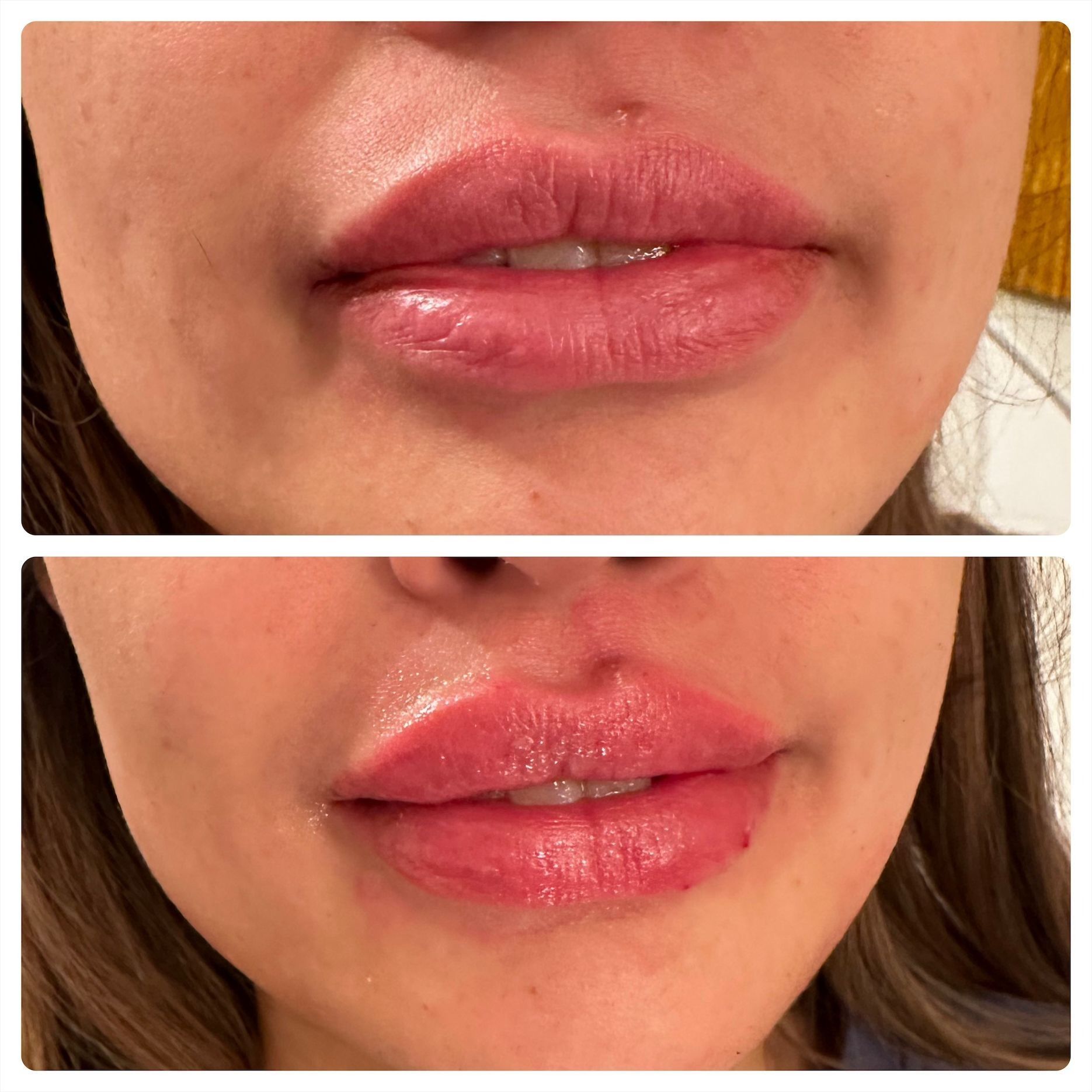 Two side-by-side lip photos: top, before lip filler; bottom, after lip filler. The 