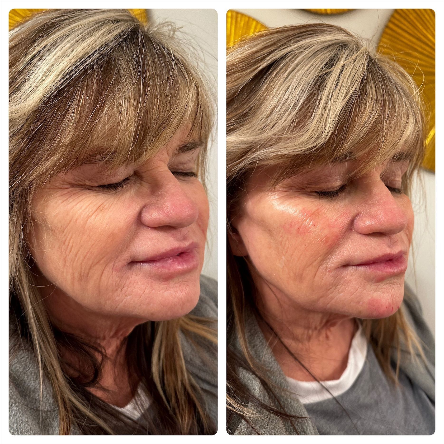 Before-and-after comparison of a woman's face after a cosmetic procedure. The 