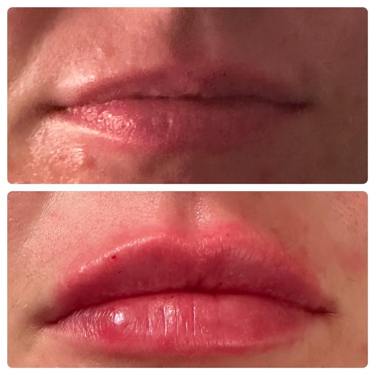 Top: Before lip filler, thin lips. Bottom: After lip filler, fuller, redder lips.