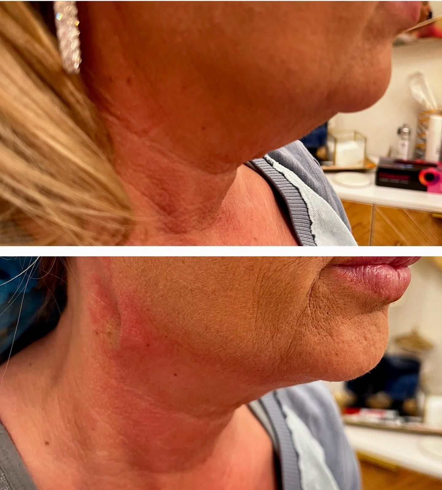 Comparison of a woman's neck before and after a procedure. The 