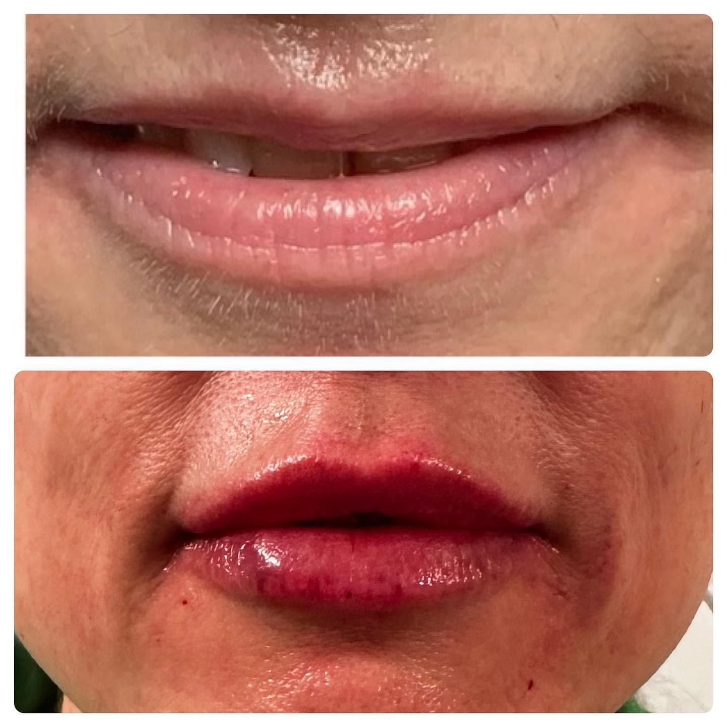 Comparison of upper lip before and after lip filler. Top: thin, pale lips. Bottom: full, dark red lips.