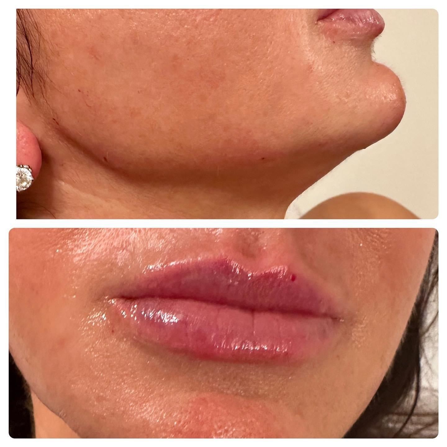 Top: Side view of a person's chin. Bottom: Close up of full, glossy lips. Both are against a neutral background.