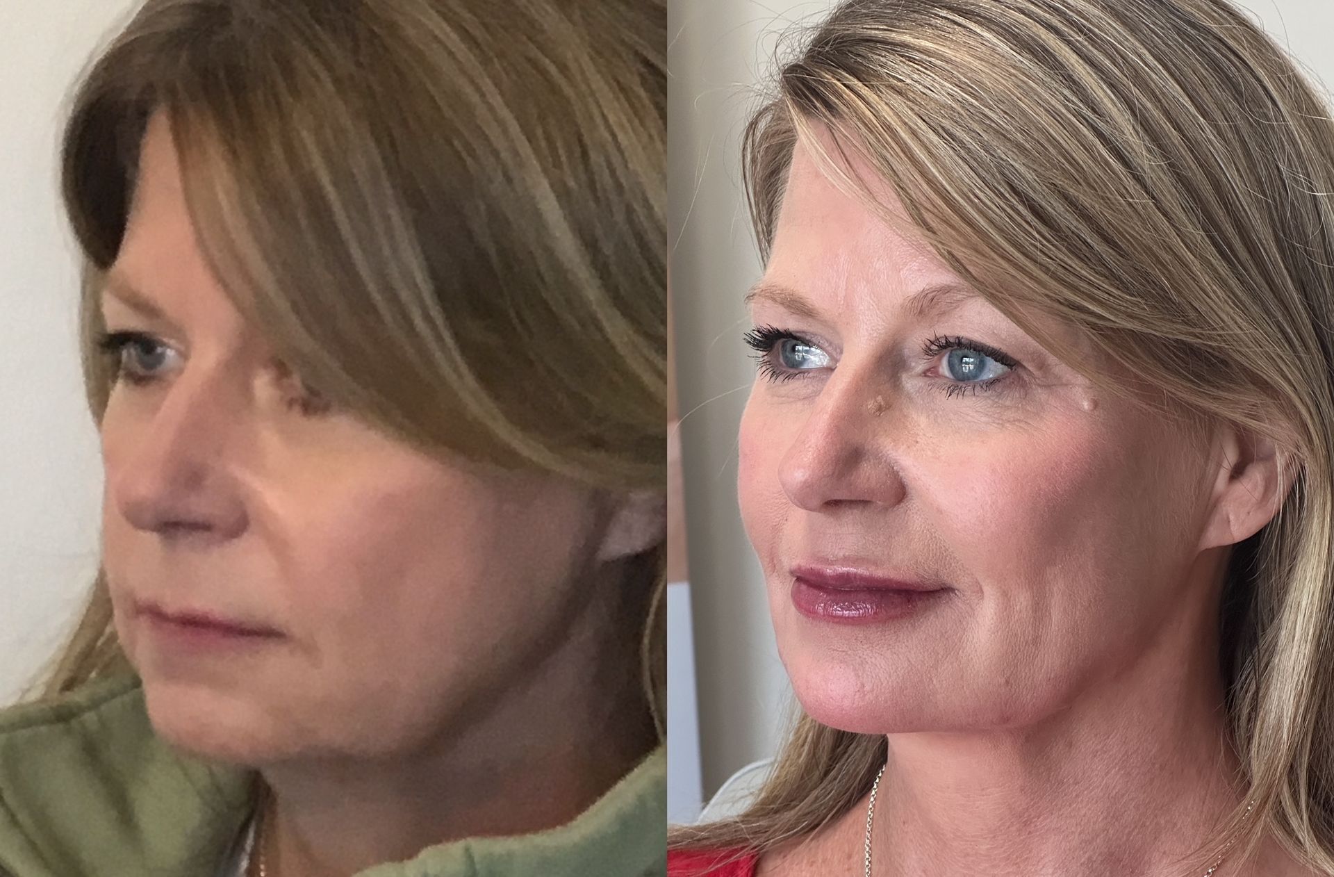 Side-by-side comparison of a woman before and after cosmetic work. The 