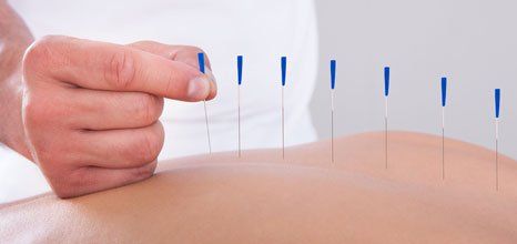 acupuncture