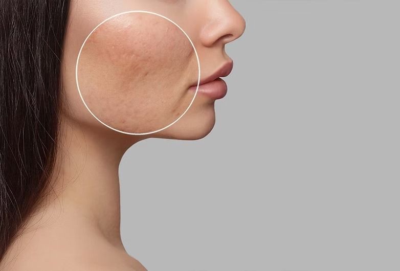 Side profile of a face with a white circle highlighting a cheek blemish or skin spot