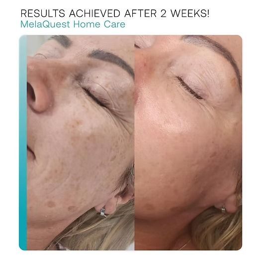 Side-by-side close-up of a face before and after two weeks of skin treatment, showing reduced dark spots.