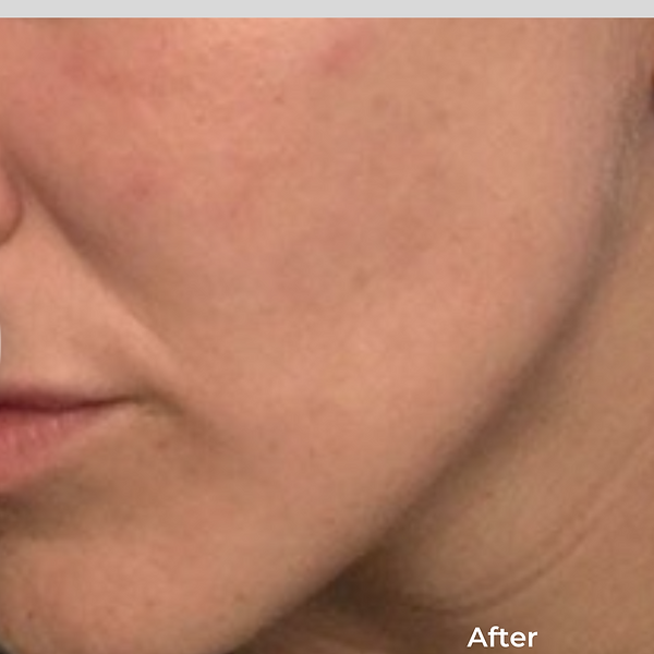 Close-up of a cheek and jawline with smooth skin, labeled “After” in the corner